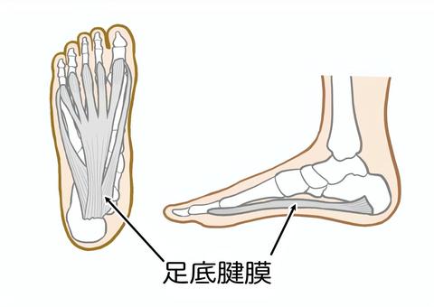 足底筋膜炎について